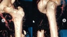 Erice Van Leuven Breaks Both Femurs, Hip and More